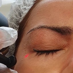 Laser frakcyjny CO2 w Dermamed medycyna estetyczna Wrocław