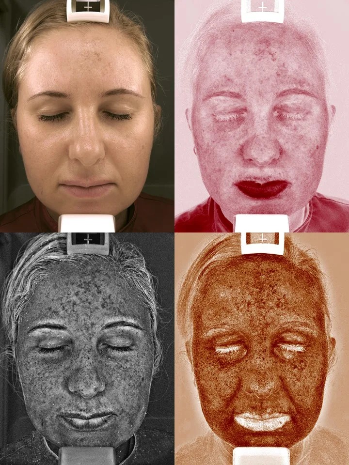 Komputerowa analiza skóry w Dermamed centrum medycyny estetycznej