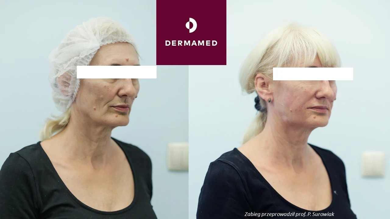 Efekt zabiegu z użyciem stymultorów tkankowych