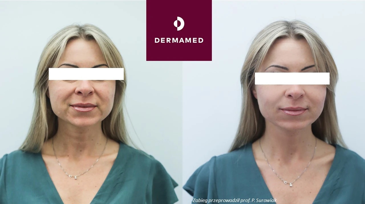 Efekt zabiegu z użyciem stymulatorów tkankowych