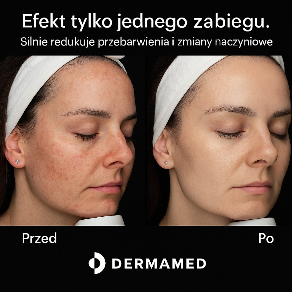 Efekt laserowego fotoodmładzania światłem szerokopasmowym.