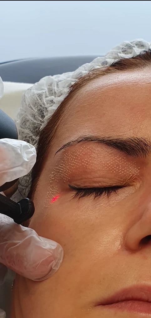 Laser frakcyjny CO2 w Dermamed medycyna estetyczna Wrocław