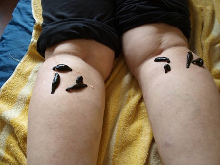 Hirudoterapia- leczenie pijawką lekarską