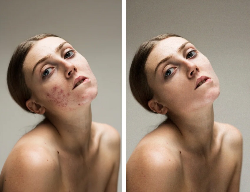 Portret kobiety przed i po retuszu. Po lewej widoczne zmiany skórne, po prawej skóra wygładzona. Neutralne tło, naturalne światło, delikatny makijaż.