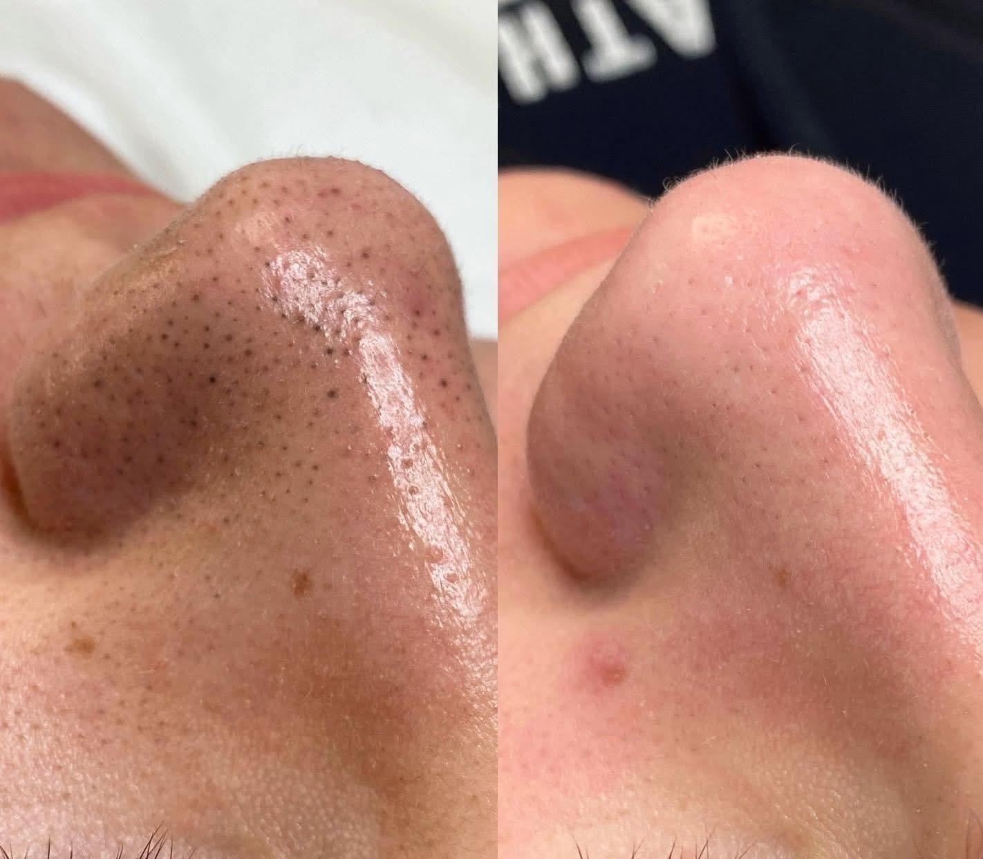 Zbliżenie nosa przed i po zabiegu oczyszczania porów. Widoczne zaskórniki na nosie po lewej stronie i czysta skóra po prawej.