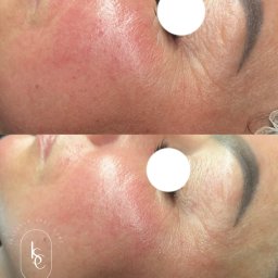 Efekt terapii skóry naczynkowej 