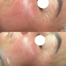 Efekt terapii skóry naczynkowej