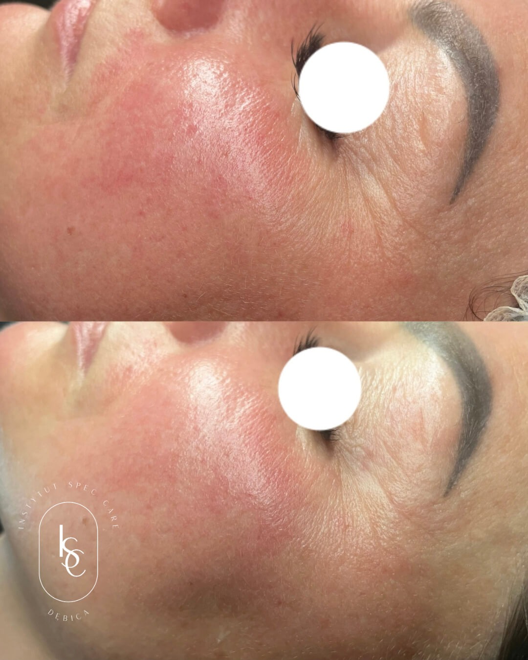 Efekt terapii skóry naczynkowej