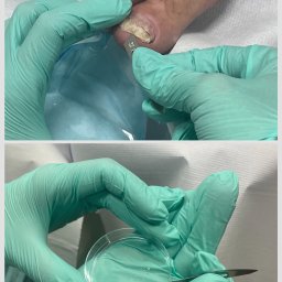 Badanie mykologiczne paznokcia