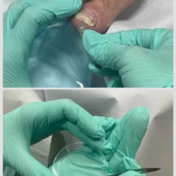 Badanie mykologiczne paznokcia