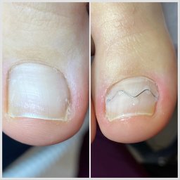 Terapia paznokcia wkręcającego 