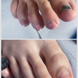 Terapia paznokcia chorobowego