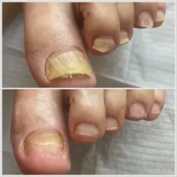 Oczyszczenie i skrócenie paznokci zrogowaciałych