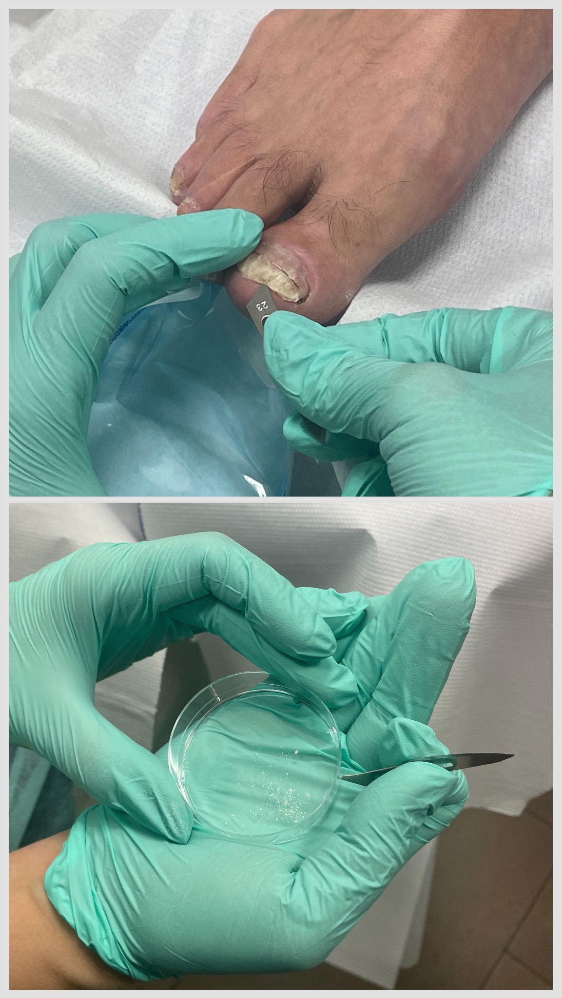 Badanie mykologiczne paznokcia