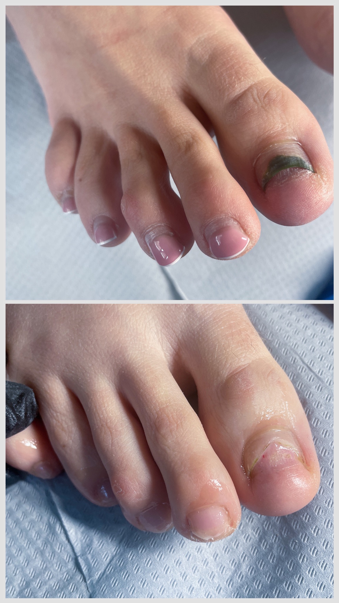 Terapia paznokcia chorobowego