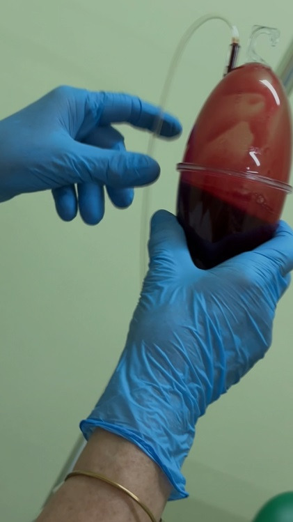 Dłoń w niebieskiej rękawiczce trzyma worek z krwią z cewnikiem. Widoczny fragment drugiej dłoni w rękawiczce i złota bransoletka na nadgarstku.