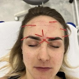 Manufaktura Zdrowia - Fizjoterapia - Masaż - Akupunktura - Kobieta z igłami do akupunktury na czole i między brwiami, leżąca na białym prześcieradle, widok z góry, bliskie ujęcie na twarz.