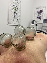 Szklane bańki na plecach pacjenta, widoczne zaczerwienienia skóry. W tle plakat z układem mięśniowym i sprzęt medyczny. Zabieg w gabinecie.