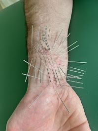 Akupunktura nadgarstka: cienkie igły wbite w skórę, widoczne włosy na ręce, zielone tło. Bliski kadr na dłoń podczas zabiegu.