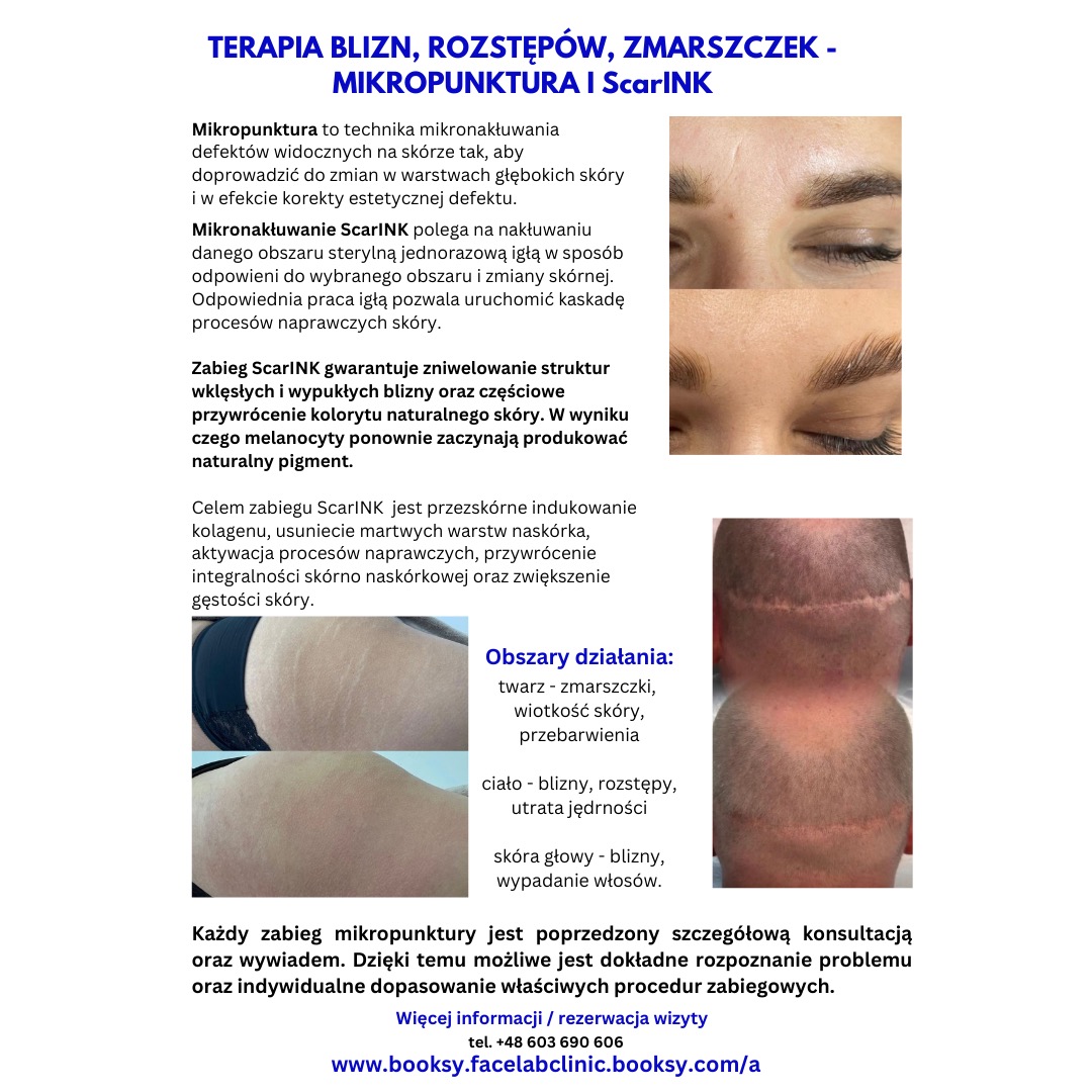 Mikropunktura ScarINK: terapia blizn, rozstępów, zmarszczek. Obszary działania: twarz, ciało, skóra głowy. Konsultacja i indywidualne dopasowanie zabiegów.