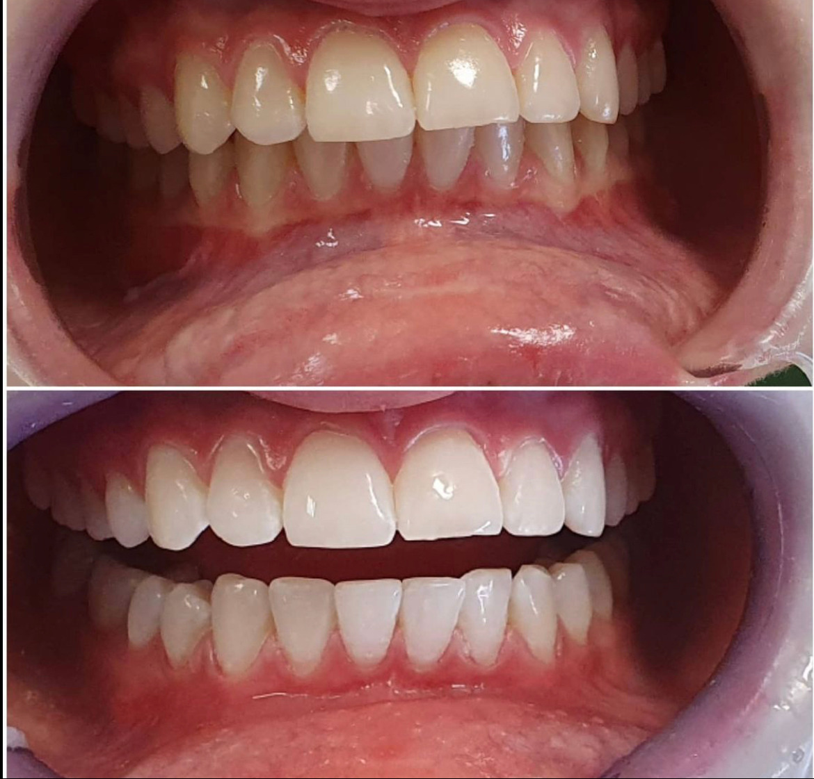 Efekt wybielania zębów: porównanie przed i po. Górny kadr ukazuje naturalny odcień, dolny - jaśniejszy, wybielony uśmiech. Widoczne detale struktury zębów.