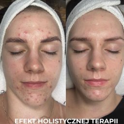 oczyszczanie skory z nawilżeniem i maską LED