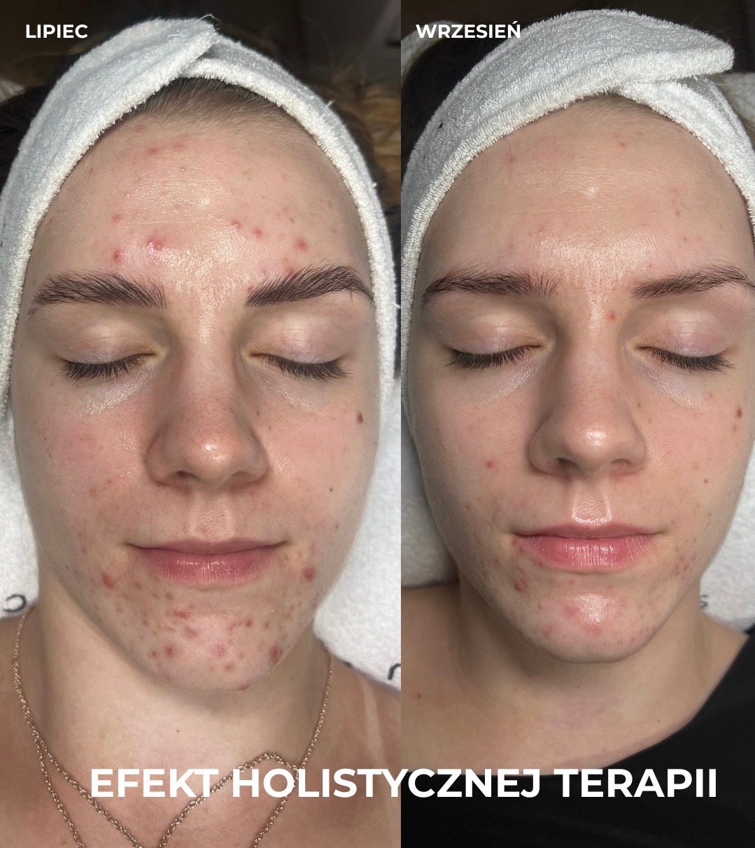 oczyszczanie skory z nawilżeniem i maską LED