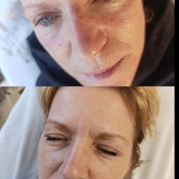 Zabiegi laserowe -zamykanie naczynek