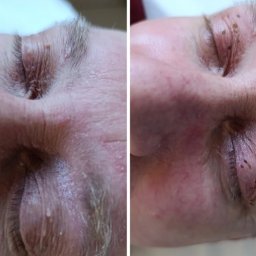 Usuwanie włókniaków 