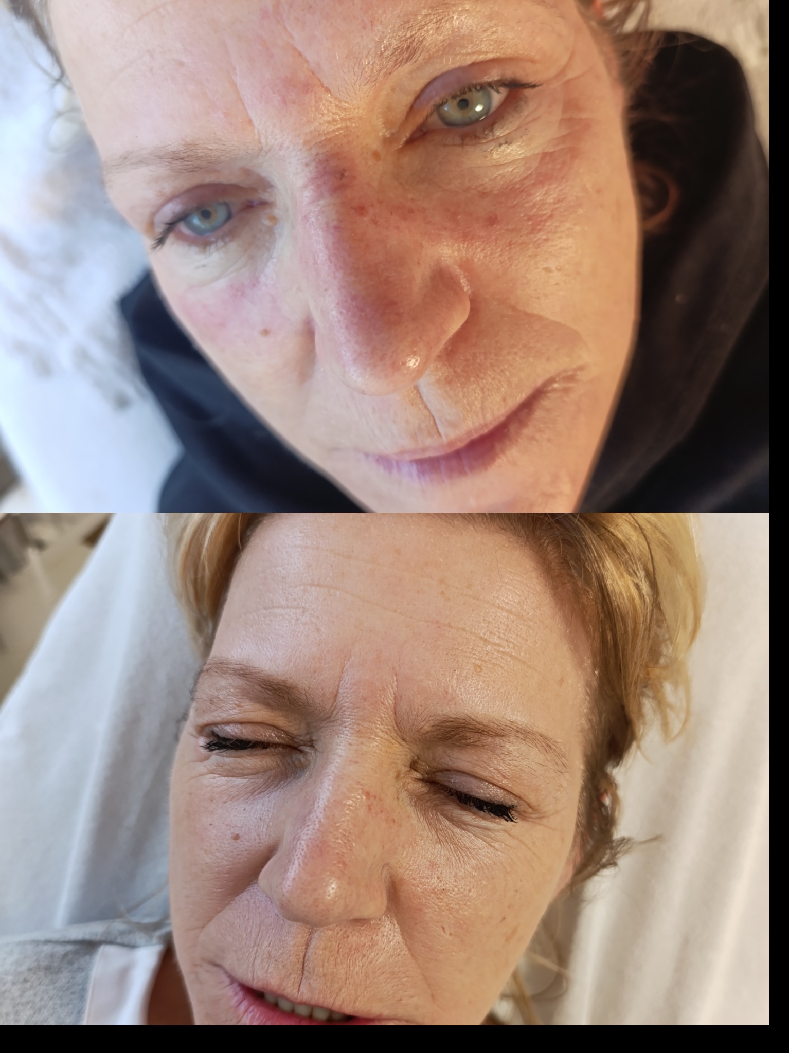 Zabiegi laserowe -zamykanie naczynek