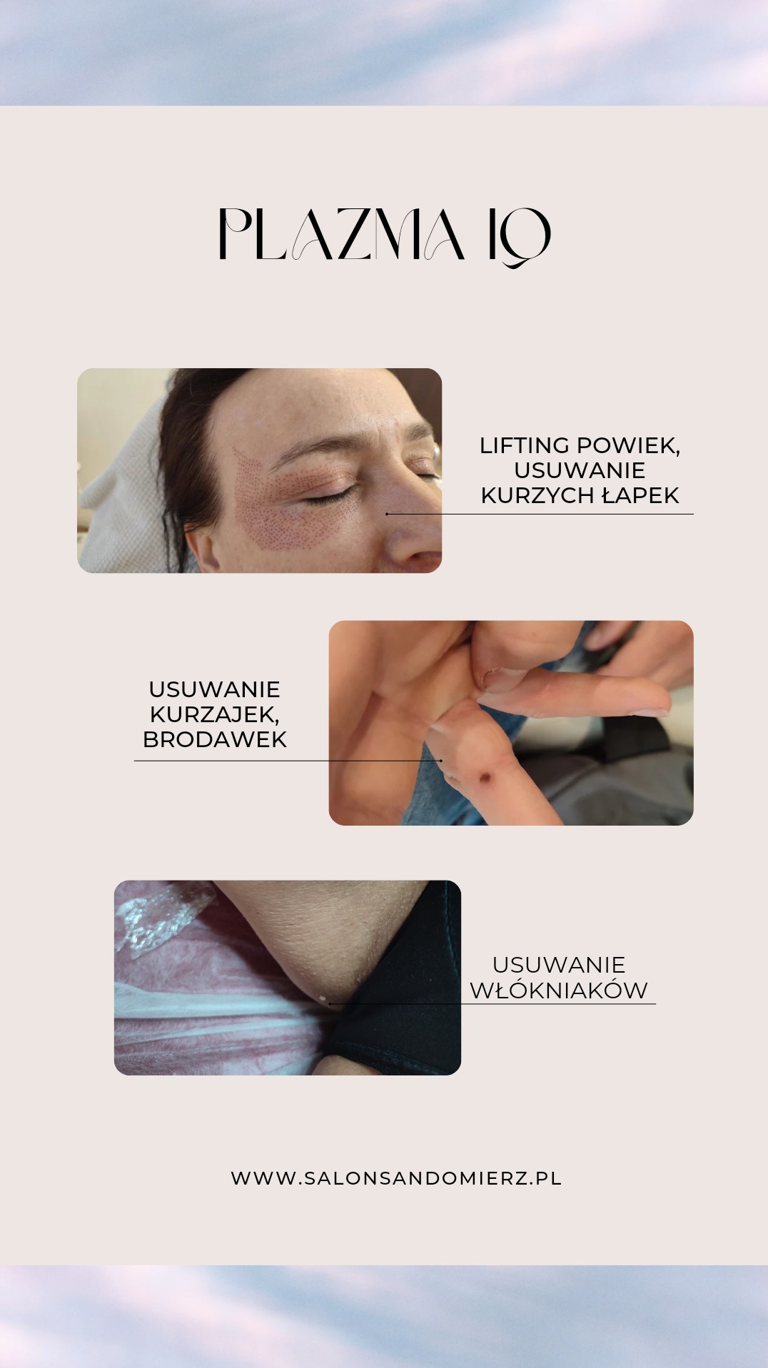 Grafika salonu kosmetycznego prezentująca efekty zabiegów Plazma IQ: lifting powiek, usuwanie kurzych łapek, kurzajek, brodawek i włókniaków. Widoczne zbliżenia na skórę.