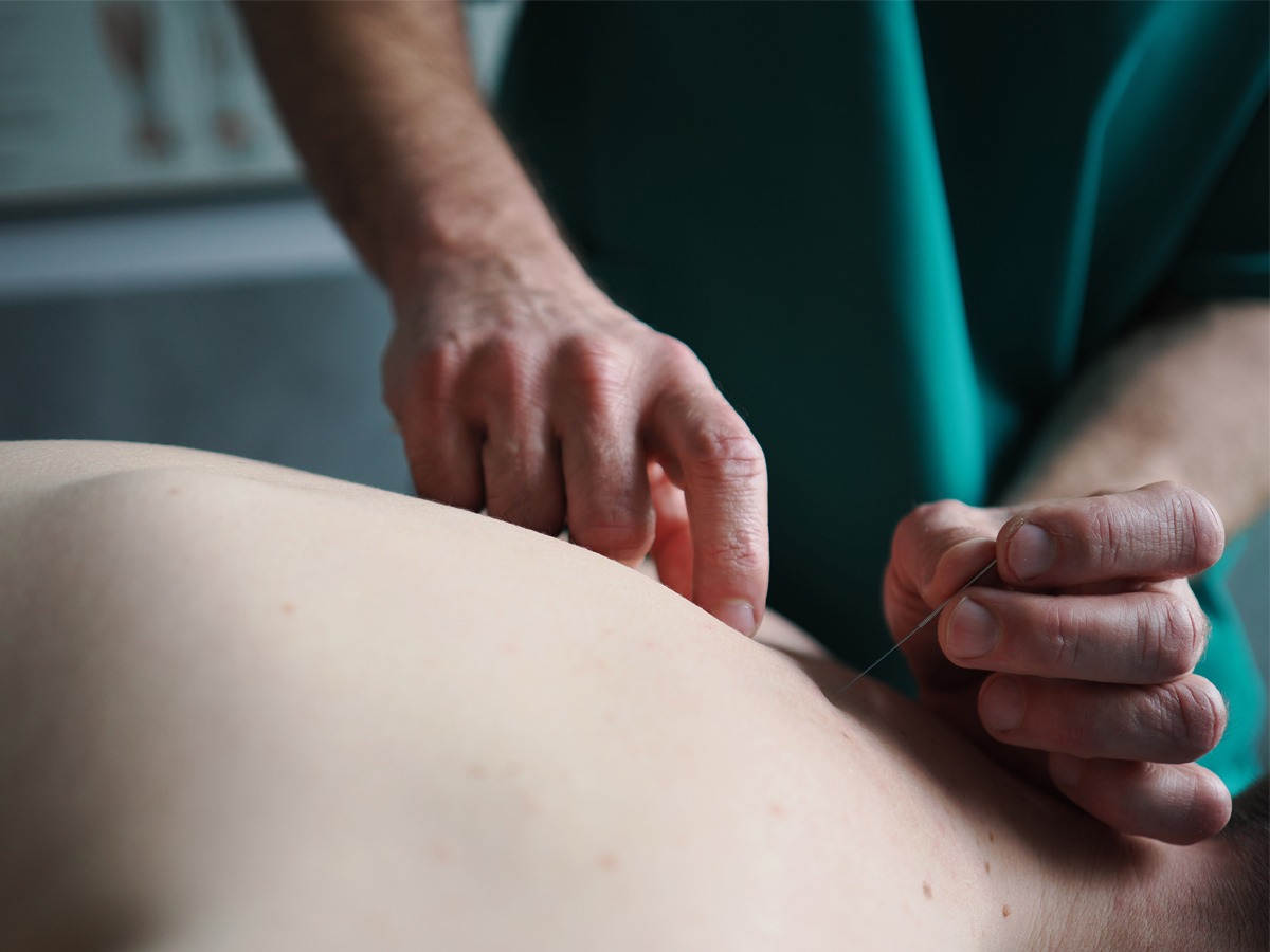 akupunktura