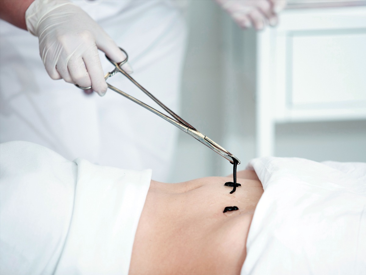 hirudoterapia