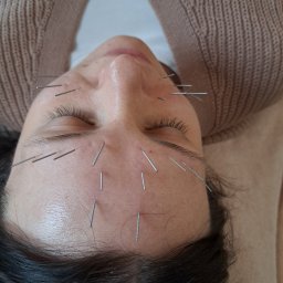 FizjoMed Gabinet Fizjoterapii i hirudoterapii mgr Gabriela Dąbrowiecka - Twarz kobiety podczas zabiegu akupunktury, z igłami umieszczonymi na czole i w okolicach oczu. Widok z góry, miękkie oświetlenie, beżowe tło. Zamknięte oczy.