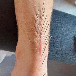 FizjoMed Gabinet Fizjoterapii i hirudoterapii mgr Gabriela Dąbrowiecka - Nakłucia akupunkturowe na przedramieniu pacjenta, widoczne cienkie igły w skórze, wykonane blisko blizny. Zabieg wykonany na tle medycznym.