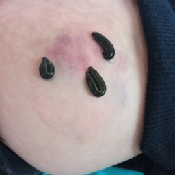 FizjoMed Gabinet Fizjoterapii i hirudoterapii mgr Gabriela Dąbrowiecka - Hirudoterapia: trzy pijawki medyczne na skórze pacjenta, widoczne ślady po ukąszeniach i niewielkie zasinienia. Zabieg w trakcie wykonywania, zbliżenie.