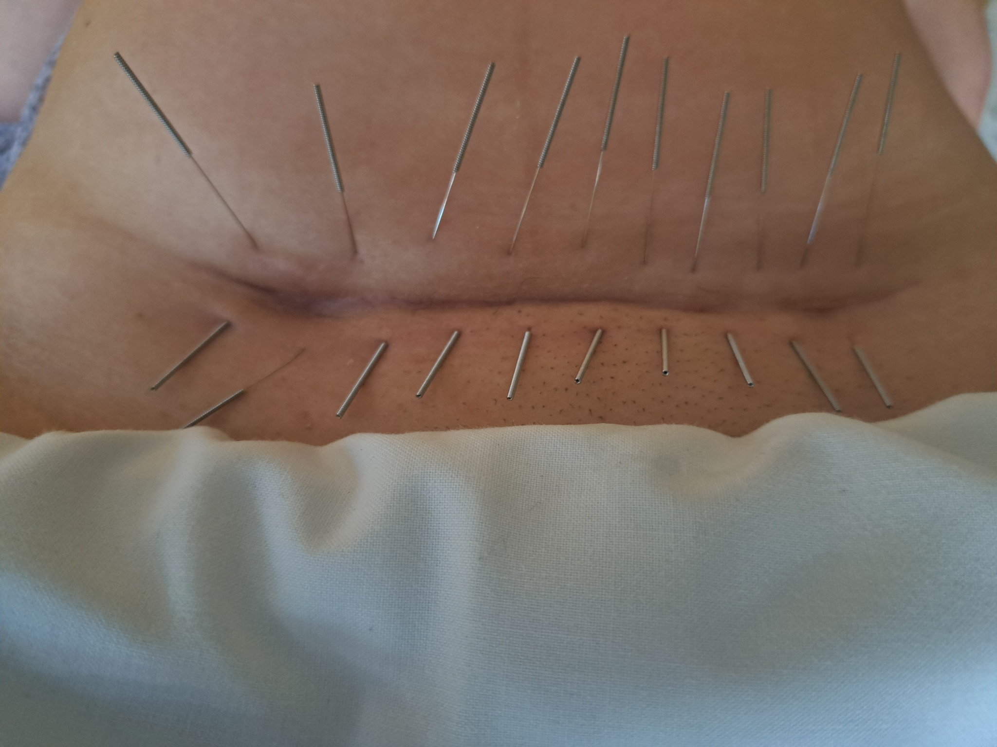 Aplikacja igieł do akupunktury na brzuchu pacjenta leżącego na białym prześcieradle. Widoczne liczne igły wbite w skórę.