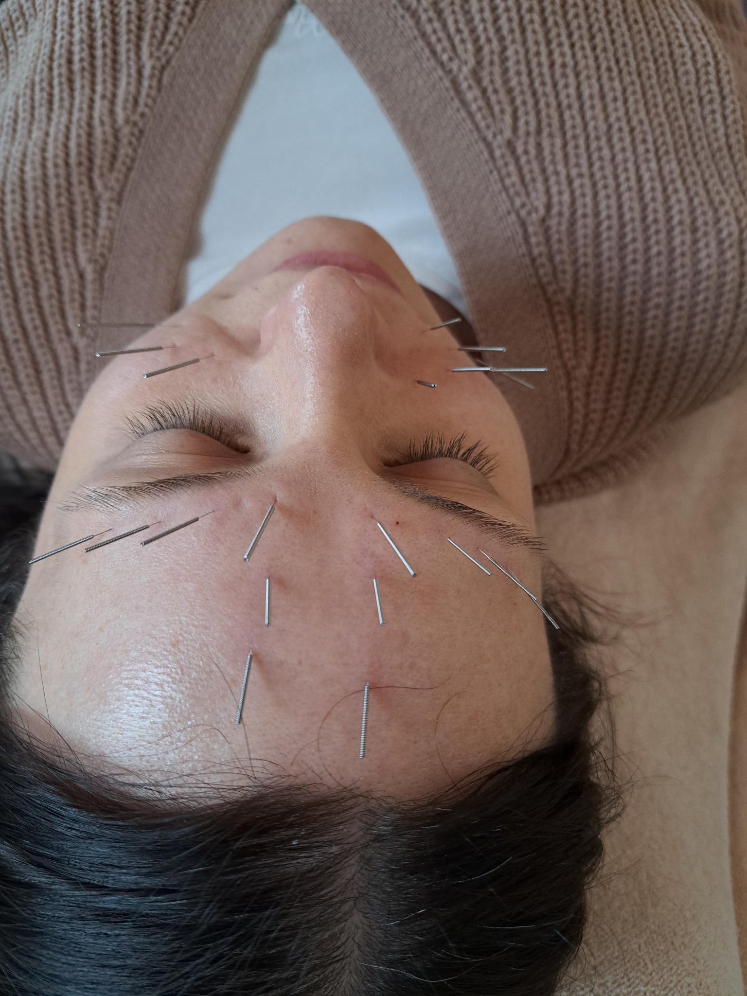 Twarz kobiety podczas zabiegu akupunktury, z igłami umieszczonymi na czole i w okolicach oczu. Widok z góry, miękkie oświetlenie, beżowe tło. Zamknięte oczy.