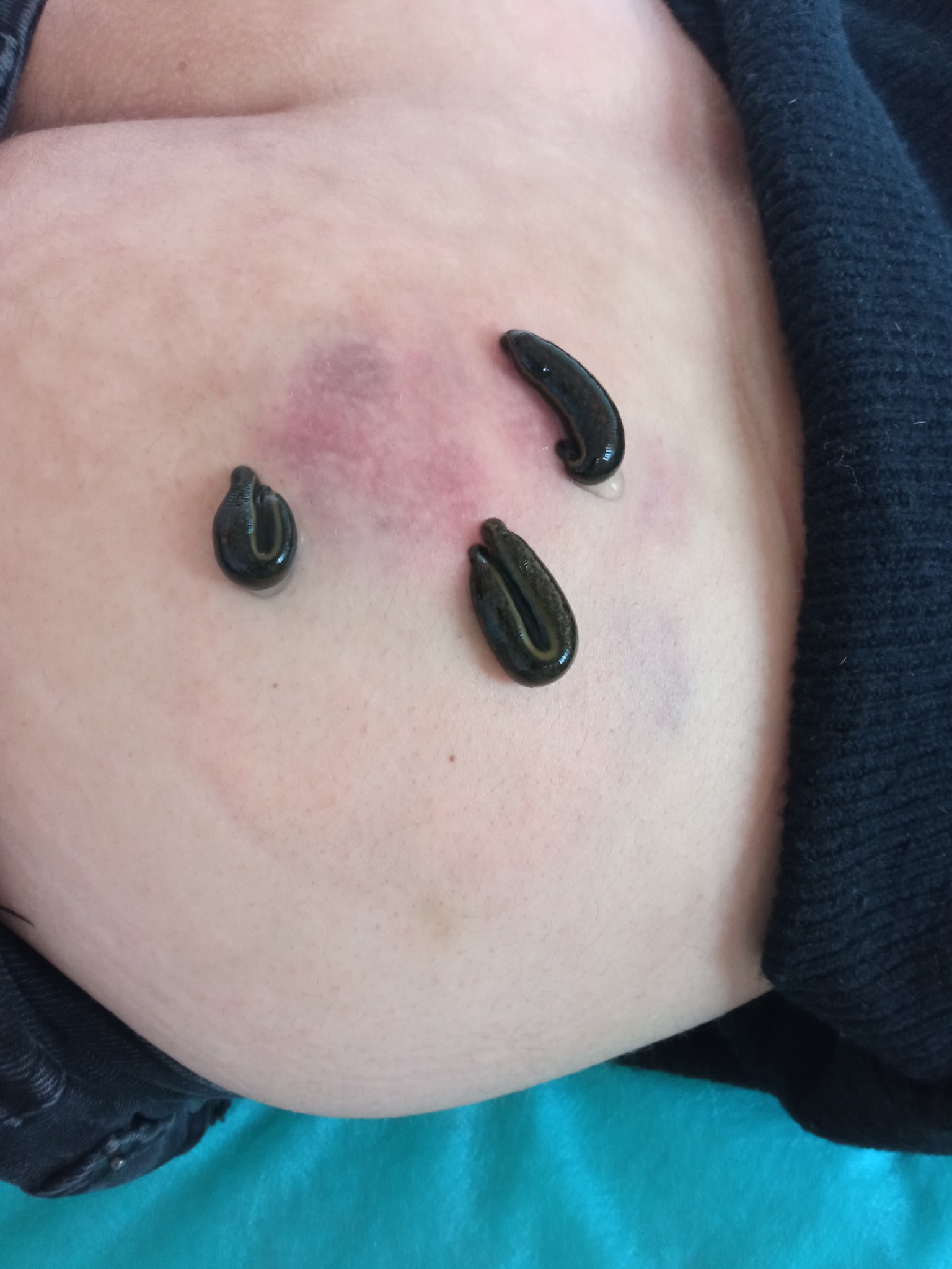 Hirudoterapia: trzy pijawki medyczne na skórze pacjenta, widoczne ślady po ukąszeniach i niewielkie zasinienia. Zabieg w trakcie wykonywania, zbliżenie.