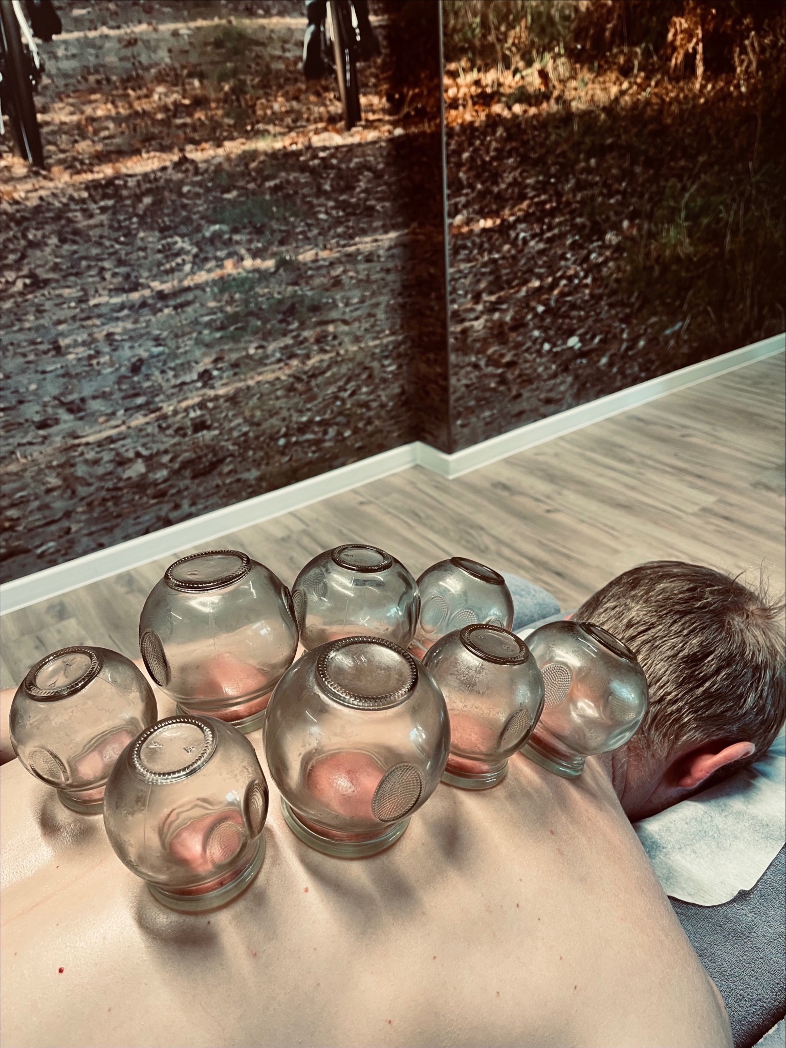 Mężczyzna leży na brzuchu z bańkami próżniowymi na plecach. Widoczny fragment ściany z fototapetą przedstawiającą leśną ścieżkę. Zabieg akupunktury.