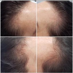 Skin-Medic klinika medycyny estetycznej (Klinika AK sp z oo) - Zdjęcie 'przed i po' zagęszczania włosów, ukazujące różnicę w gęstości i wyglądzie włosów na skórze głowy. Widoczne detale skóry i włosów.
