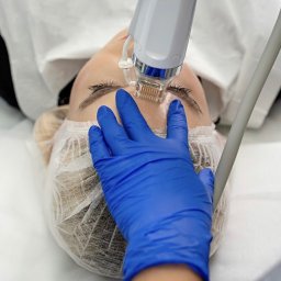 Skin-Medic klinika medycyny estetycznej (Klinika AK sp z oo) - Kobieta poddaje się zabiegowi mezoterapii mikroigłowej na czole w salonie kosmetycznym. Widoczne dłonie w niebieskich rękawiczkach i urządzenie z igłami.