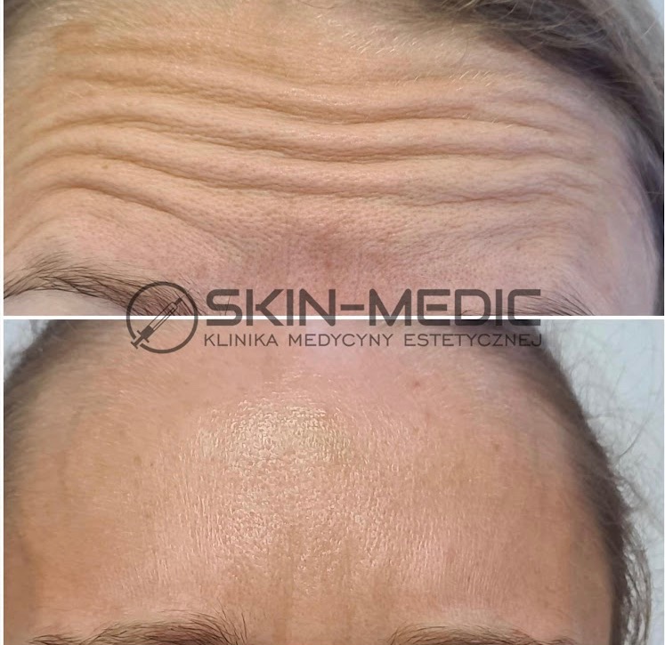 Efekt zabiegu redukcji zmarszczek na czole: porównanie stanu skóry przed i po zabiegu, ukazujące widoczne wygładzenie i poprawę elastyczności.