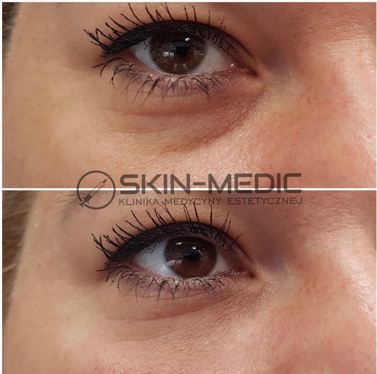 Oko kobiety przed i po zabiegu medycyny estetycznej. Widoczne zmiany w zmarszczkach i cieniach pod okiem. Logo kliniki Skin-Medic.