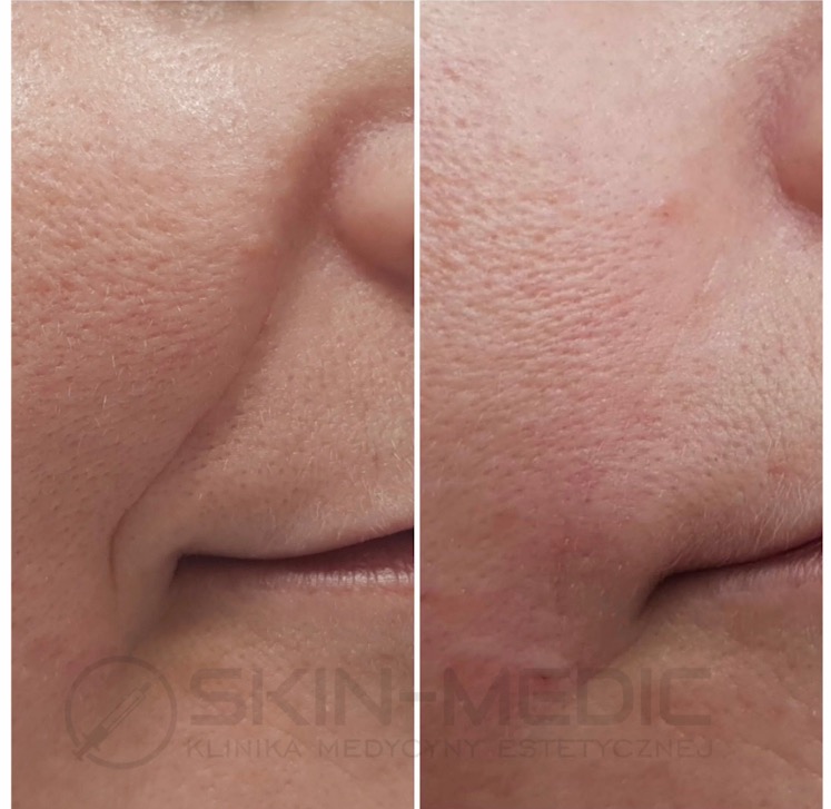 Zbliżenie na skórę twarzy przed i po zabiegu, widoczne zmniejszenie zmarszczek i poprawa tekstury skóry w okolicach ust i nosa. Efekt zabiegu odmładzającego.