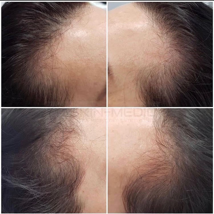 Zdjęcie 'przed i po' zagęszczania włosów, ukazujące różnicę w gęstości i wyglądzie włosów na skórze głowy. Widoczne detale skóry i włosów.