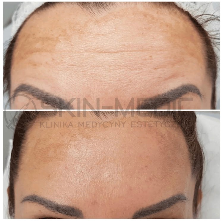 Zdjęcie 'przed i po' redukcji przebarwień na czole kobiety, wykonane w klinice medycyny estetycznej. Widoczne zmiany w pigmentacji skóry.