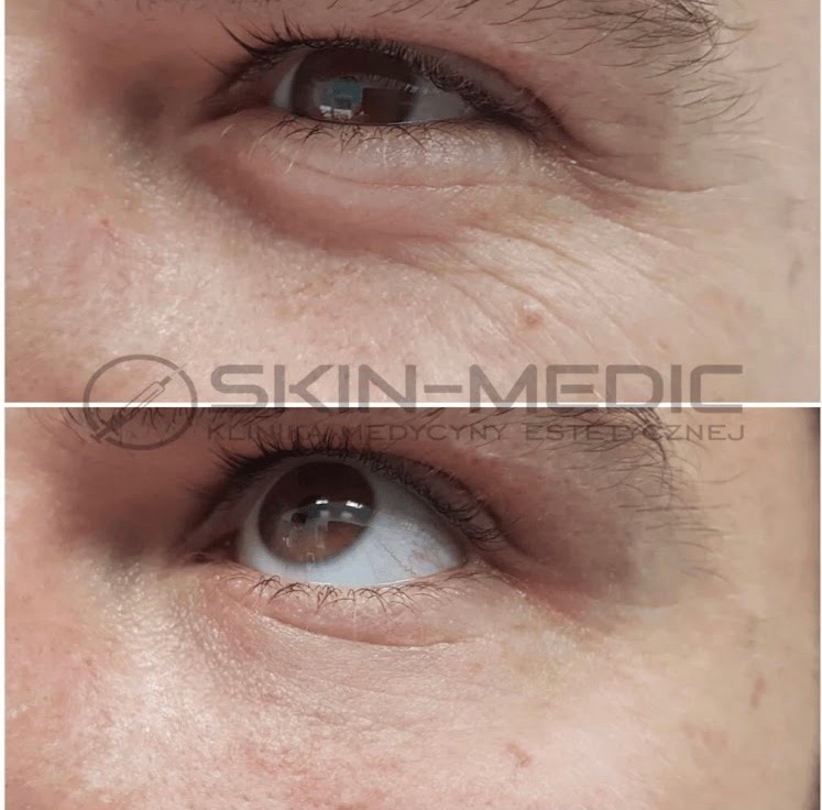 Zbliżenie na oko przed i po zabiegu redukcji zmarszczek, z logo kliniki medycyny estetycznej Skin-Medic. Widoczne zmiany w strukturze skóry pod okiem.