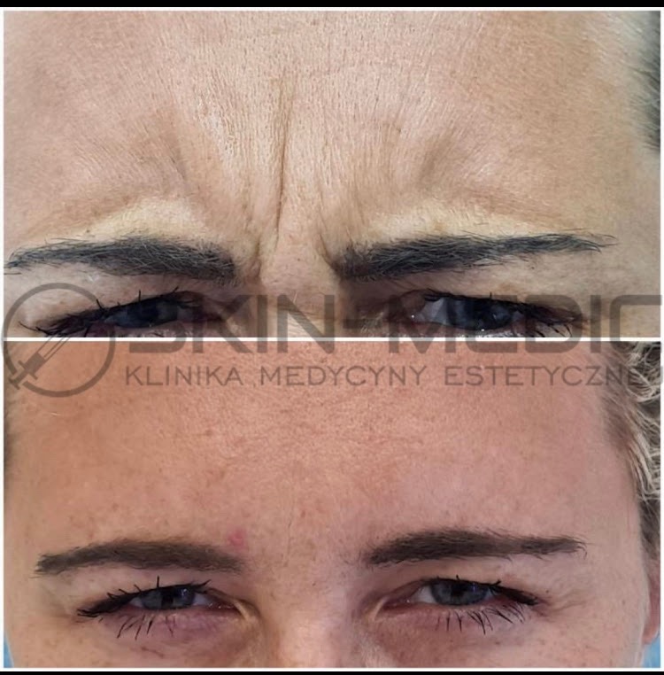 Zdjęcie 'przed i po' redukcji zmarszczek na czole w klinice medycyny estetycznej. Widoczne wyraźne różnice w gładkości skóry.