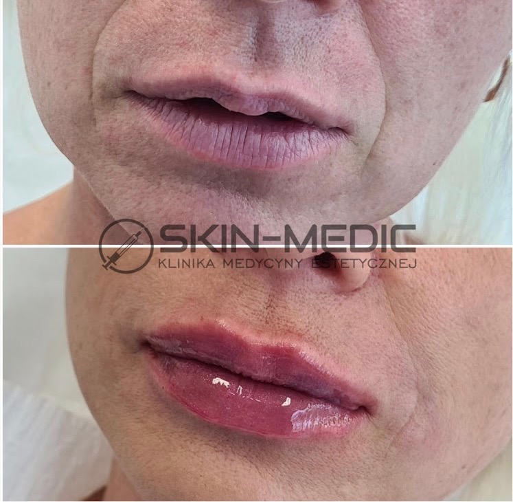 Powiększanie ust kwasem hialuronowym: efekt przed i po zabiegu w klinice medycyny estetycznej. Usta jędrne, nawilżone, z wyraźnym konturem i objętością.